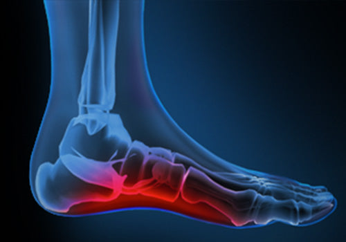 Arch Pain