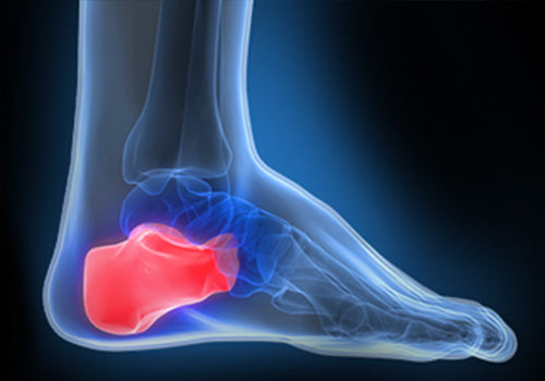 Heel Pain