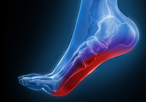 Plantar Fasciitis