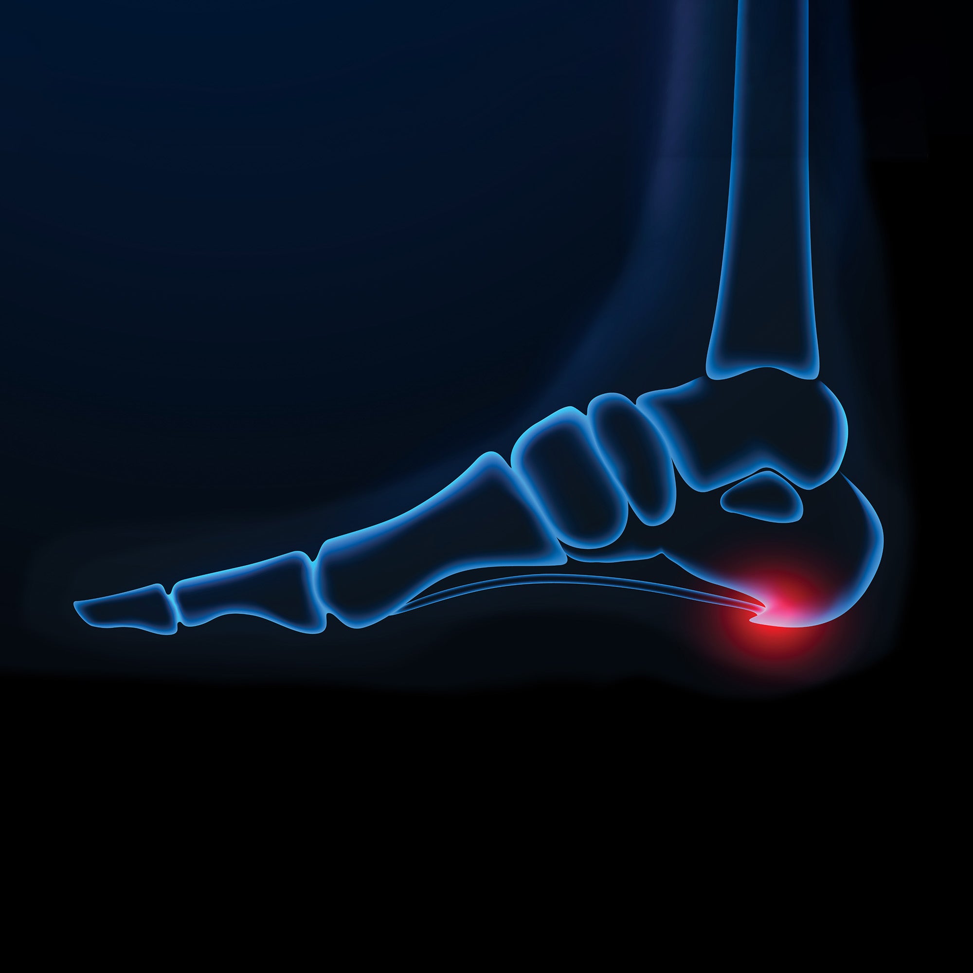 heel spurs in foot