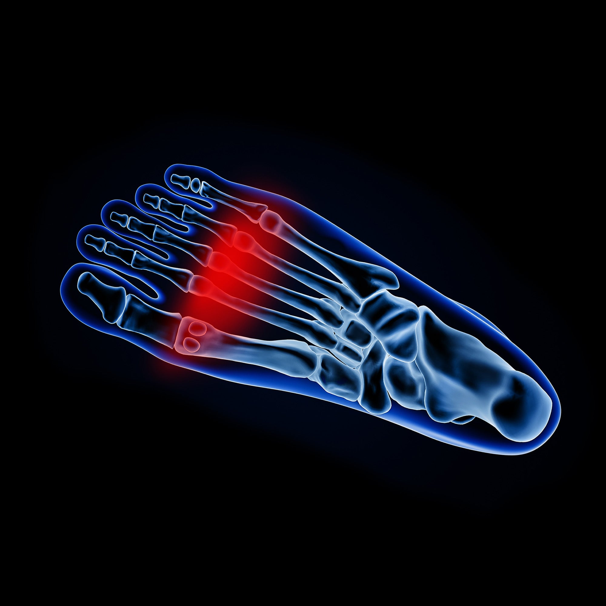 metatarsalgia in foot