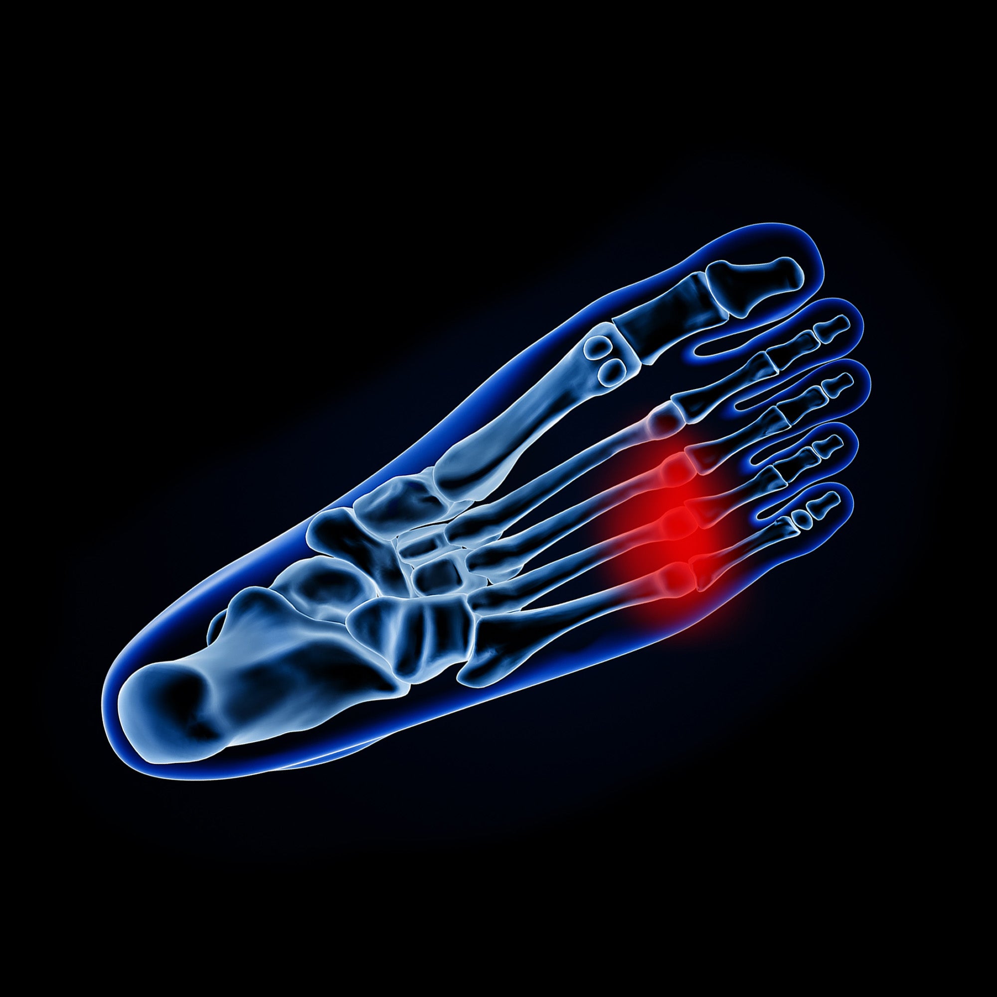 morton's neuroma in foot
