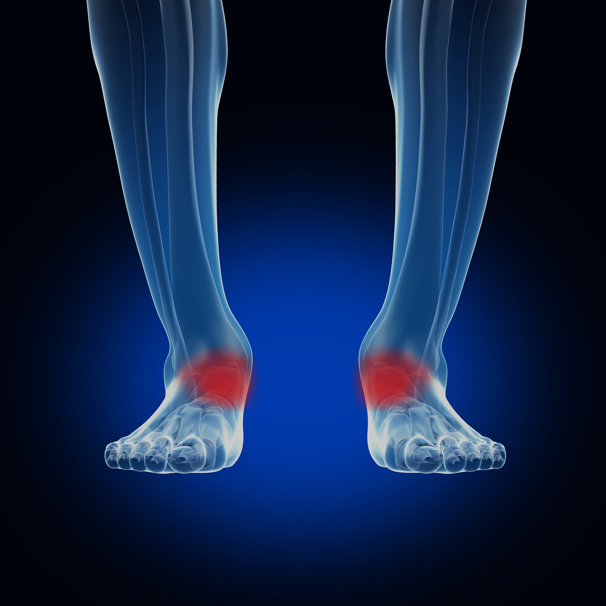 overpronation on feet