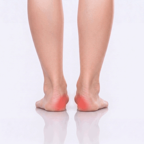 red on the inside of the feet indicating overpronation