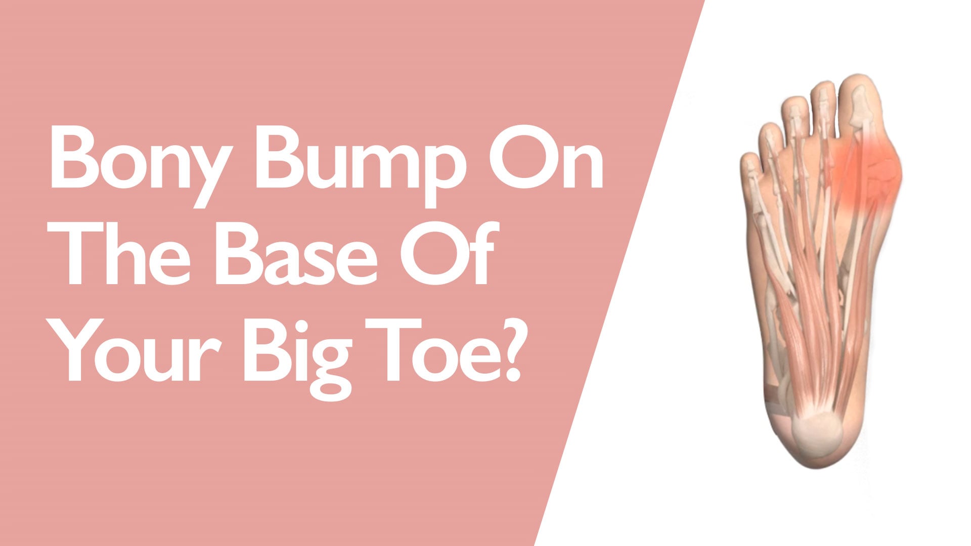 Illustration of a foot with a bony bump on the base of the big toe, accompanied by text about a bony bump on the base of the big toe.