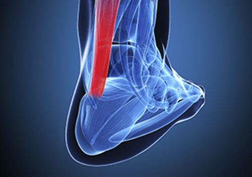 Achilles Tendonitis