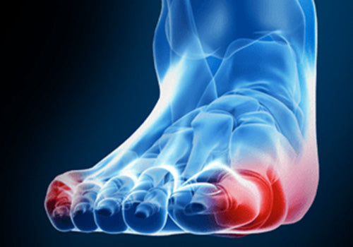 Bunions