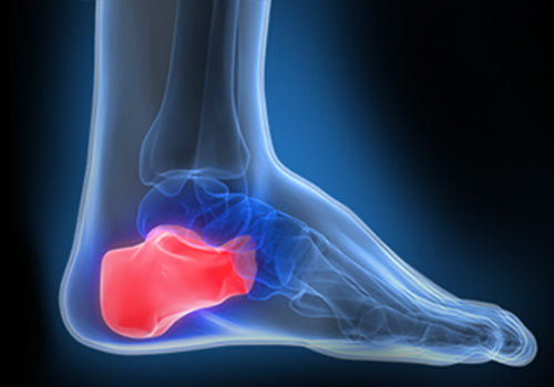 Heel Spurs