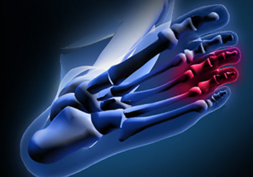 Morton's Neuroma
