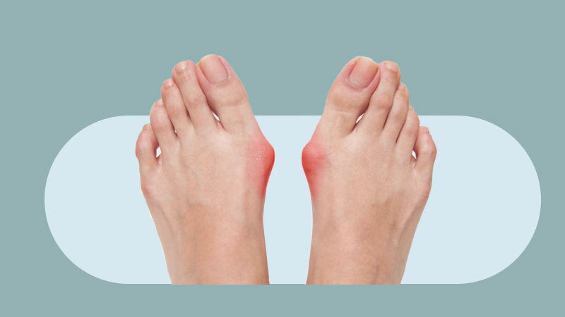 Orthotics for Bunions