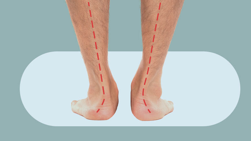 Orthotics for Overpronation
