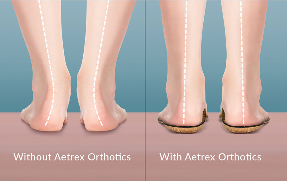 Aetrex helps with alignment
