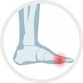 Gout on Foot