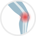 Osteoarthritis (OA) of Knee