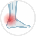 Rheumatoid Arthritis (RA) on foot