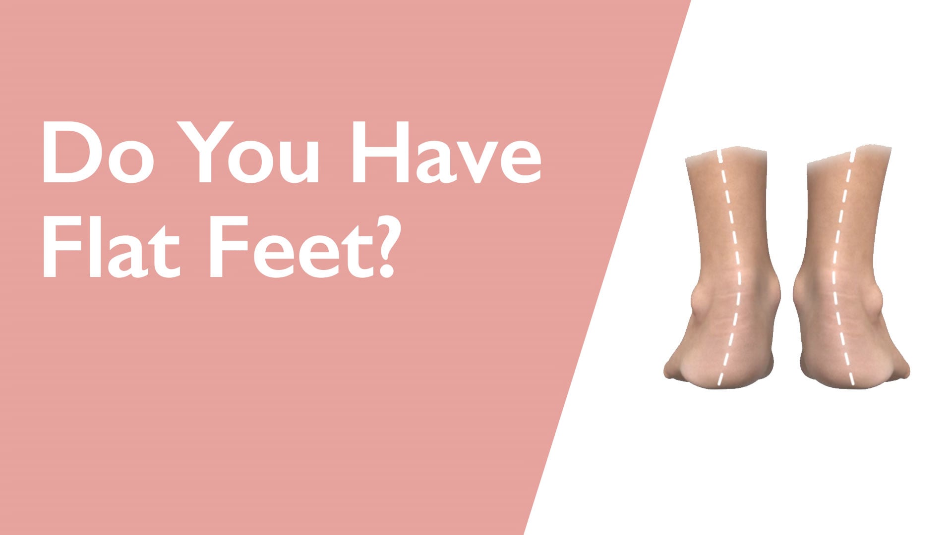 Transparent foot-shaped socks with text 'Do You Have Flat Feet?' on a pink and white background